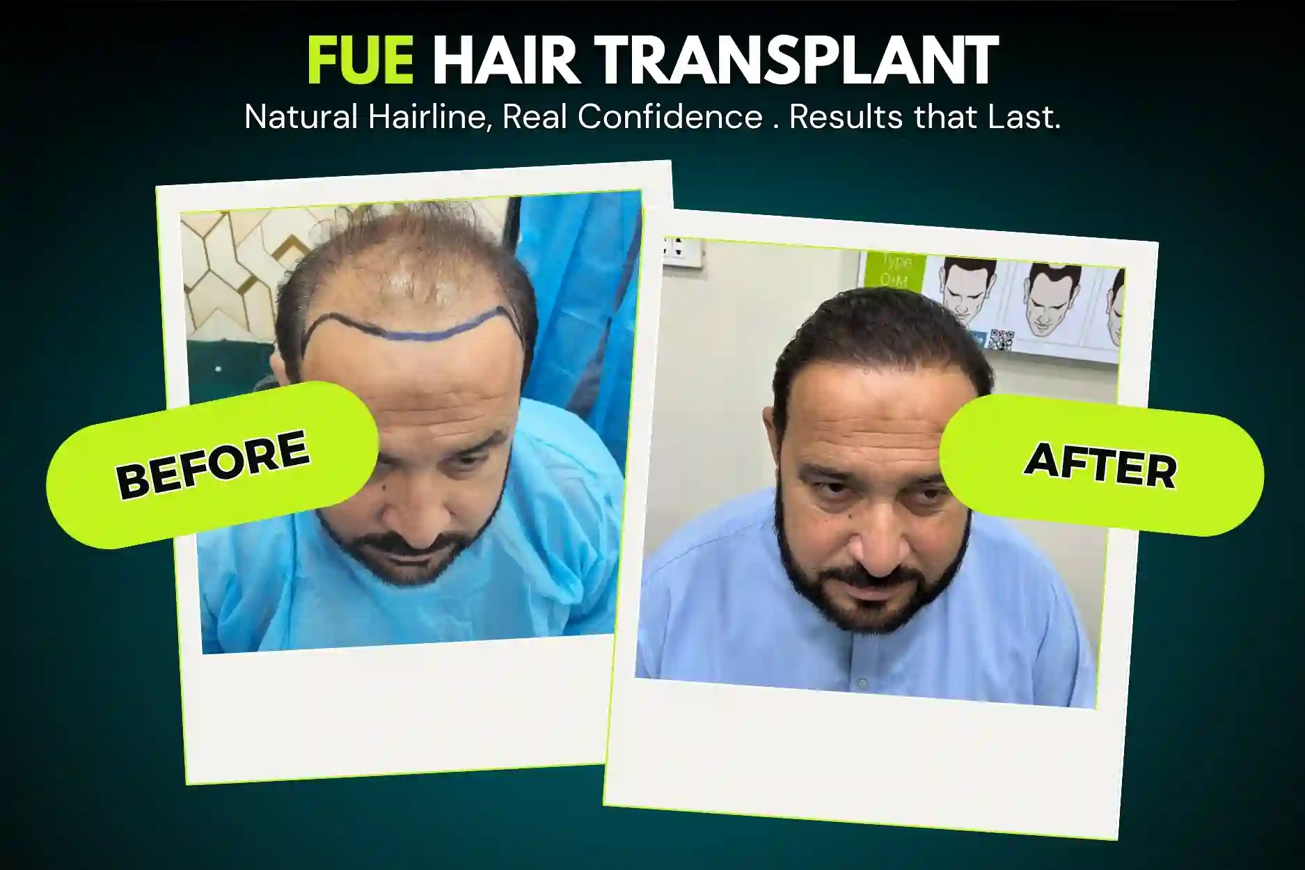 FUE Hair Transplant Before and After Results - SMC Aesthetics Karachi